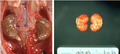 Interstitial Nephritis