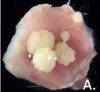 Urinary Calculi