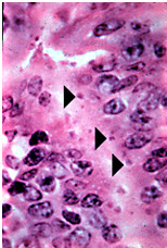 Cryptosporidiosis