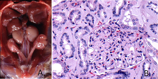 Amyloidosis