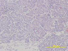 Alveolar/Bronchiolar Carcinoma