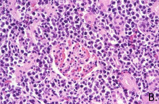 Lymphosarcoma