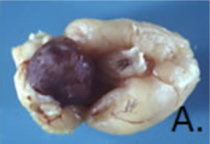 Pituitary Chromophobe Adenoma