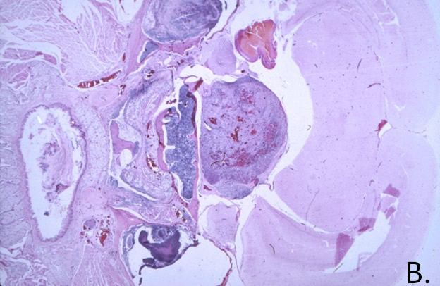 Pituitary Chromophobe Adenoma