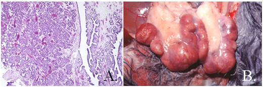 Uterine Adenocarcinoma