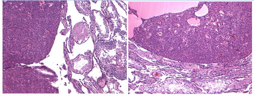 Interstitial Cell Tumor