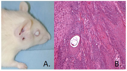 Zymbal’s Gland Tumor