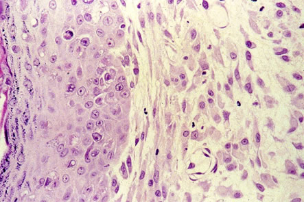 Rabbit (Shope) Fibroma Virus