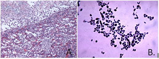 Streptococcal Disease