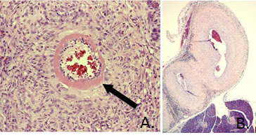 Polyarteritis nodosa