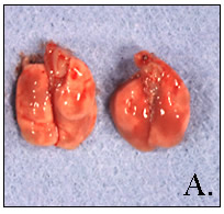 Pneumocystis pneumonia